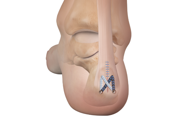 Arthrex - Implant System, BioComposite Achilles SpeedBridge - AR 